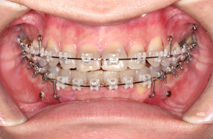 Treatment Review: No-Prep Laminate for Tetracycline-Stained Teeth image 8