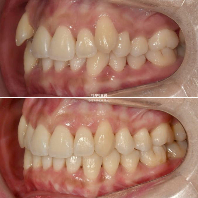 인비절라인 비발치 제2대구치 발치 사랑니 대체 교정 심한 덧니 교정 치료 관련 이미지 23