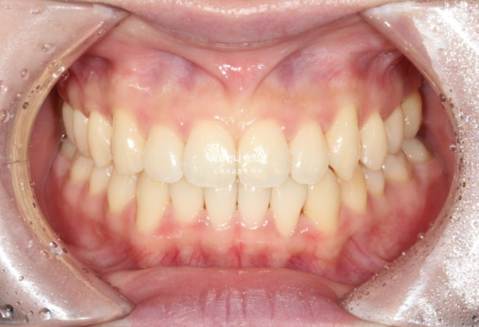 인비절라인 교정 비발치 비대칭 덧니 중심선 선천적 결손치 교정? 관련 이미지 14