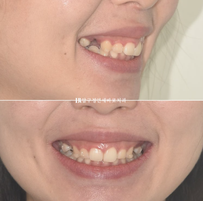 Does Invisalign Prevent Root Movement? Before-and-After Comparison of Extraction Treatment for Protruding Lips image 3