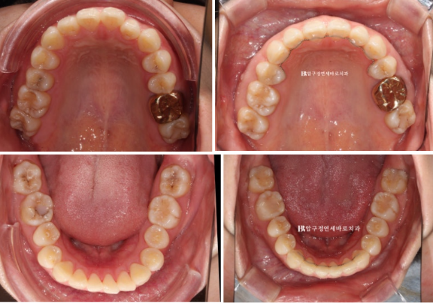 Gummy Smile Correction Review | Natural Improvement of Gummy Smile and Buccal Corridors Through Extraction Treatment for Protruding Teeth image 10