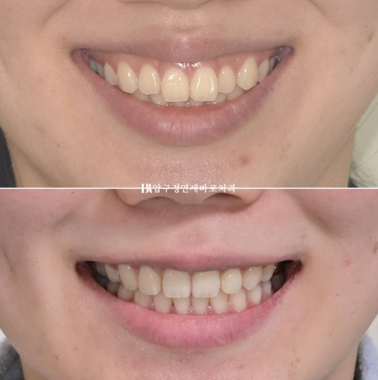 Gummy Smile Correction, Gummy Smile Orthodontics, Rabbit Teeth Correction image 1