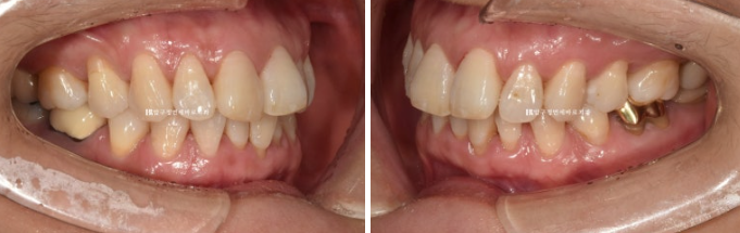50대 치아교정 인비절라인 라이트 앞니교정 치료 후기 관련 이미지 2