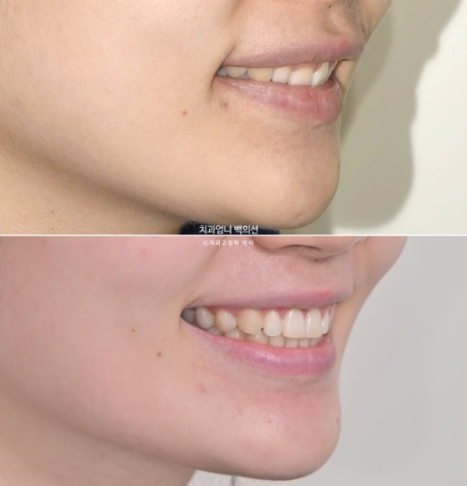 Inward-Tilted Teeth Orthodontic Treatment Review | Actual Case Improved with Non-Extraction Orthodontic Treatment for Gummy Smile, Deep Overbite & Gum Asymmetry — Gangnam Orthodontic Clinic image 20