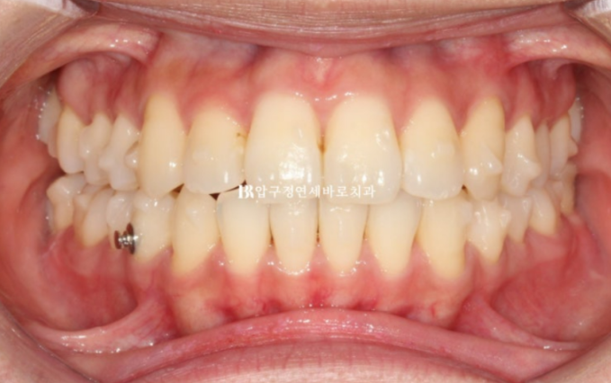Invisalign Lite Treatment for Crossbite, Rabbit Teeth, and Protruding Front Teeth Correction image 4