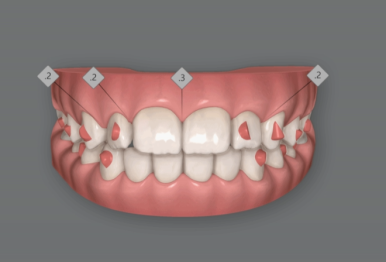 인비절라인라이트 덧니 과개교합 교정 치료기간 9개월 관련 이미지 4