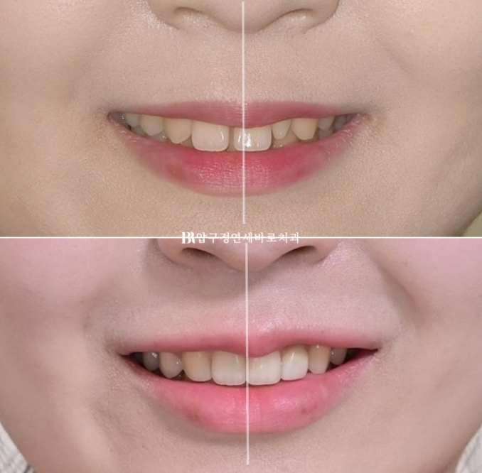 Actual Case of Treating Congenitally Missing and Peg-Shaped Teeth Without Implants image 5