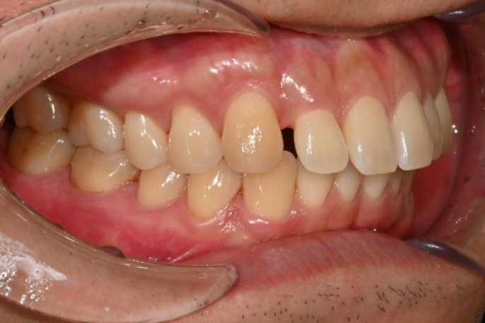 가위교합 벌어짐 중심선 과개교합 인비절라인 라이트 교정 관련 이미지 3