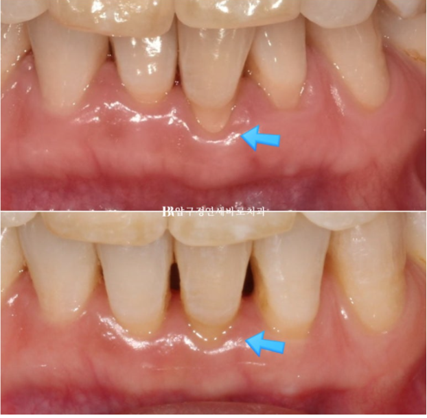 Can Invisalign Lite Work for People in Their 50s? A Real Middle-Aged Orthodontic Case Improving Butterfly Teeth and Gum Recession image 14