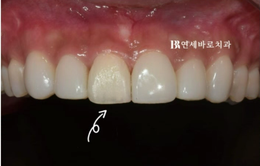 압구정 무삭제 라미네이트 가능할까? 관련 이미지 4
