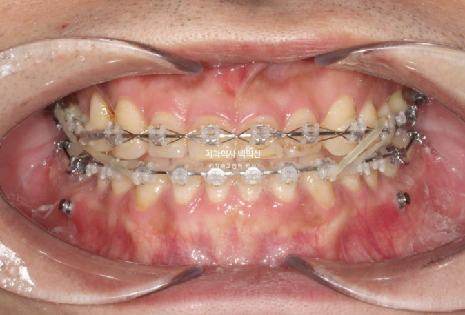 30대 주걱턱 비수술 비발치 교정 후기 관련 이미지 7
