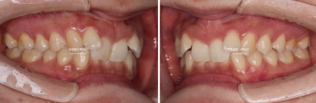 Inward-Tilted Teeth Orthodontic Treatment Review | A Real Case of Treating Congenitally Missing Lower Incisor (Three Lower Front Teeth) Without Extractions image 3