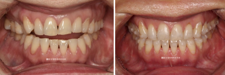 50대 인비절라인 개방교합 합입교정 미니스크류 관련 이미지 6