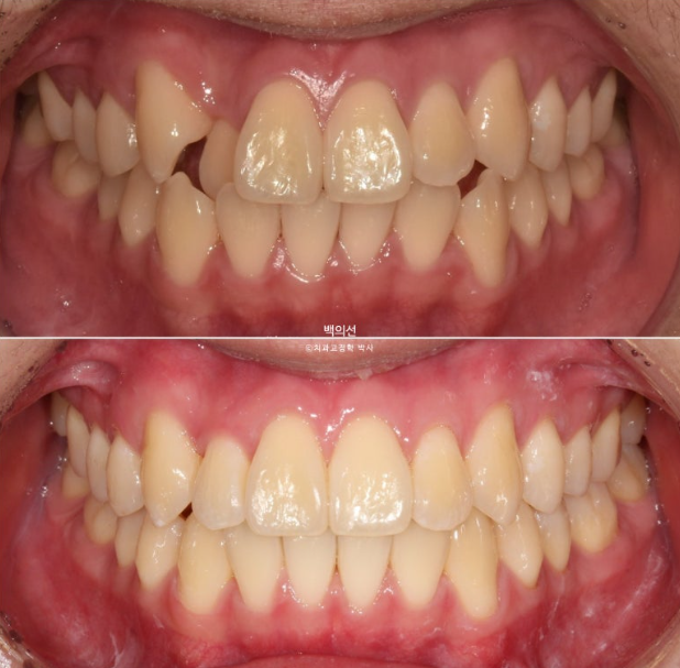 유학생 교정 덧니 반대교합 인비절라인 라이트 치료기간 관련 이미지 1