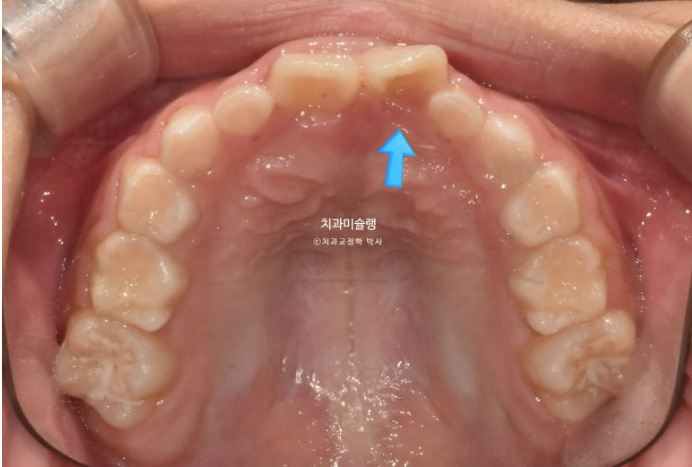 7세 어린이 반대교합 부정교합 프리올소 치료 관련 이미지 6