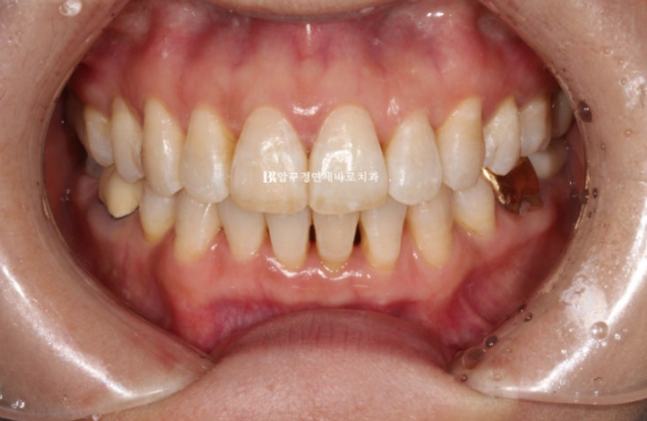 Can Invisalign Lite Work for People in Their 50s? A Real Middle-Aged Orthodontic Case Improving Butterfly Teeth and Gum Recession image 9
