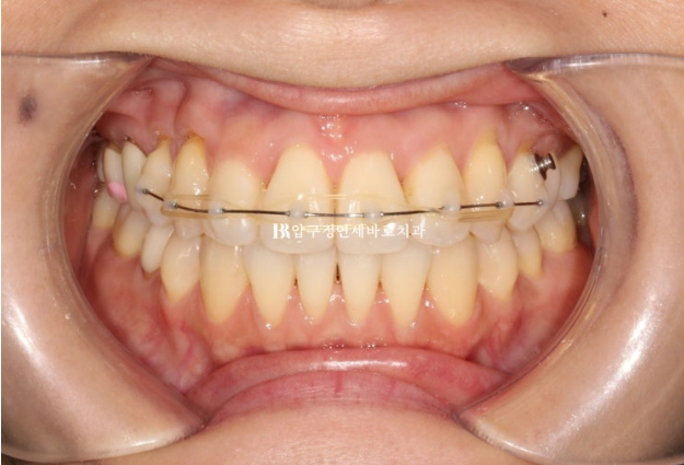 30대 토끼이빨 교정 반대교합 앞니 부분교정 후기 관련 이미지 4