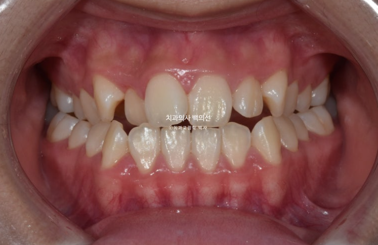 중학생 주걱턱 반대교합 개방교합 덧니 교정 인비절라인 후기 관련 이미지 1