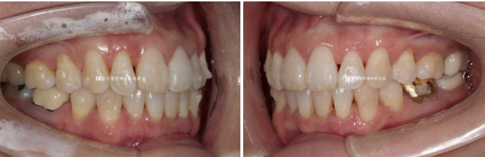 50대 치아교정 인비절라인 라이트 앞니교정 치료 후기 관련 이미지 7