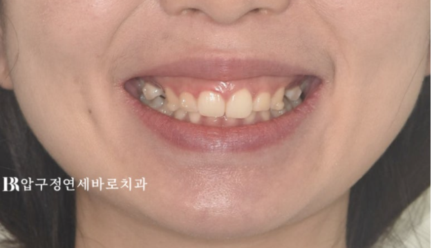 웃을 때 잇몸이 많이 보인다면? 거미스마일 원인과 교정 방법 관련 이미지 4