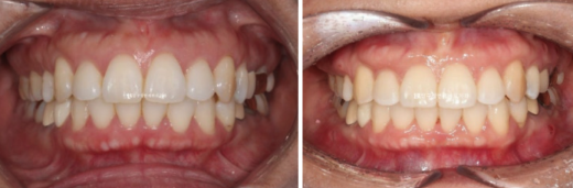 Orthodontic Retreatment in Your 40s | Improvement of Chin Retrusion and Lip Incompetence with Intrusion Orthodontics, Non-Extraction Orthodontic Treatment in Your 40s image 5
