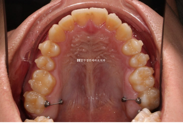 양악수술 교정 인비절라인 주걱턱 교정 치료 후기 관련 이미지 5