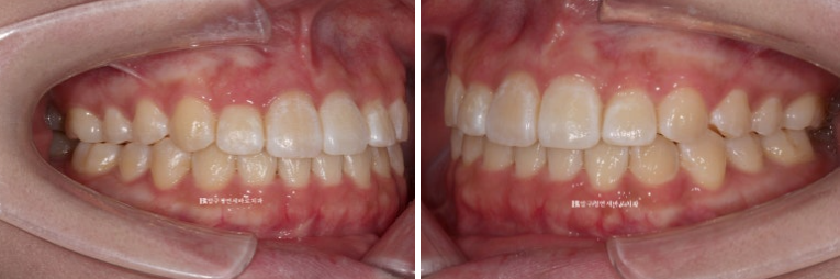 인비절라인라이트 재교정 뻐드렁니 교정 돌출 교정 관련 이미지 5
