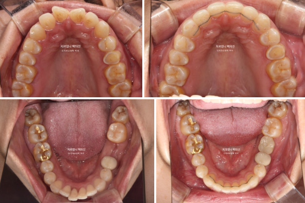 40대 인비절라인 라이트 앞니 벌어짐 뻗침 돌출 치료 관련 이미지 19