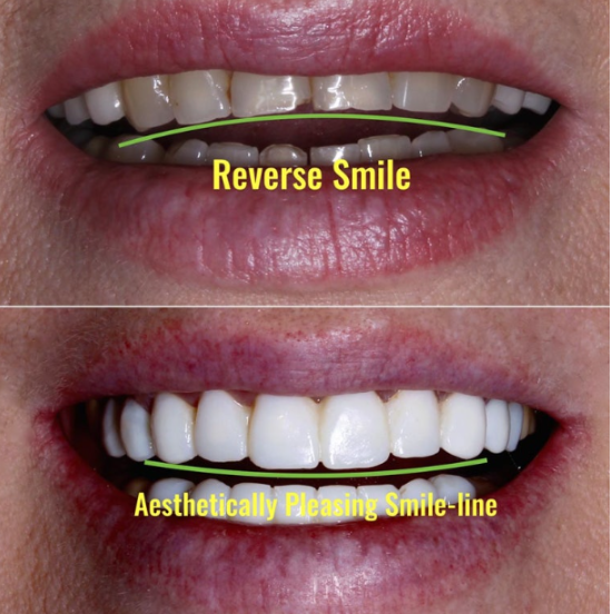 Non-Prep Veneer Review | A Case Naturally Improving Gaps Between the Front Teeth and the Smile Line image 4