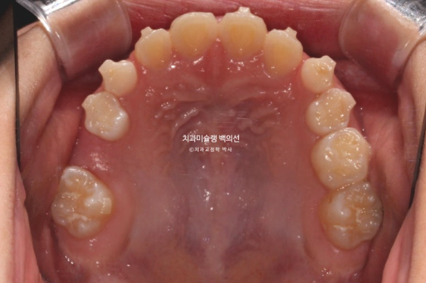 어린이 비대칭 반대교합 주걱턱 인비절라인 퍼스트 프리올소 성장 교정 관련 이미지 17