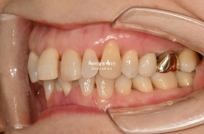 50대 치아교정 중년 발치교정 블랙트라이앵글 치료 후기 관련 이미지 4