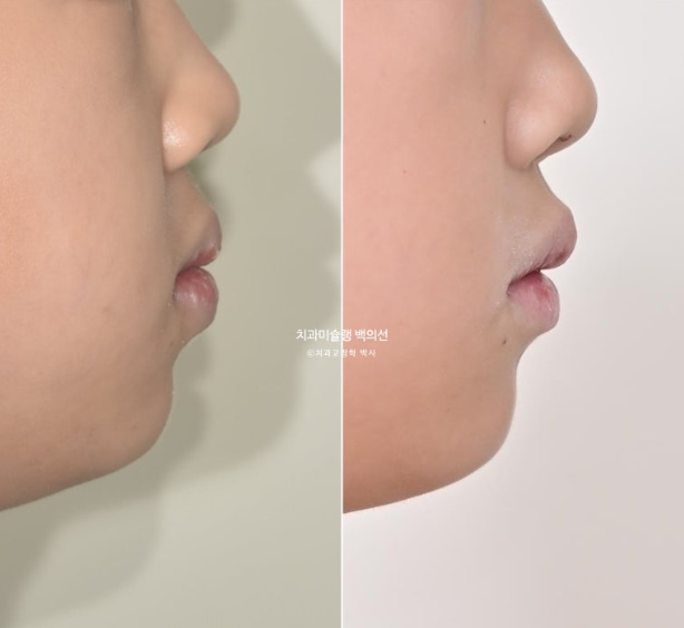 어린이 비대칭 반대교합 주걱턱 인비절라인 퍼스트 프리올소 성장 교정 관련 이미지 28
