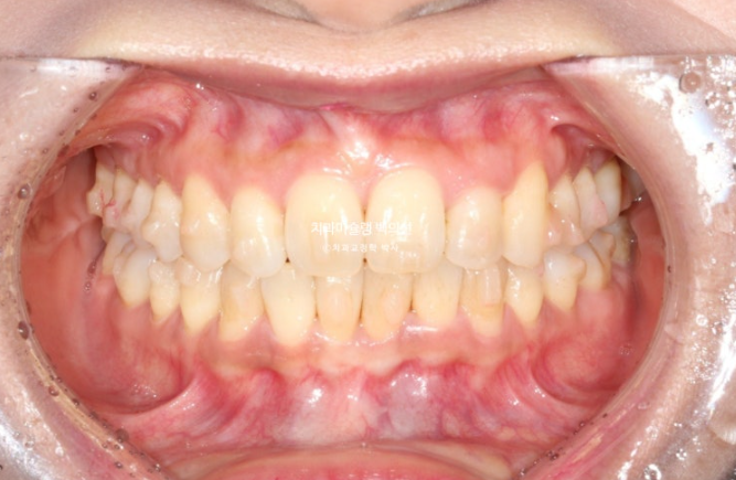 옥니 덧니 과개교합 반대교합 중심선 인비절라인 치료기간 1년 관련 이미지 7