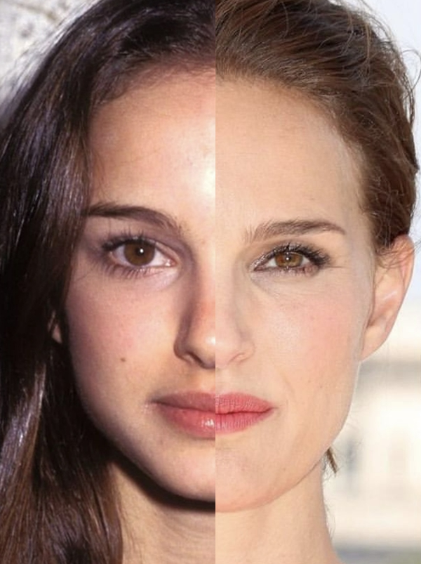 잇몸미소 거미스마일 원인에 따라 다른 치료방법? 관련 이미지 1