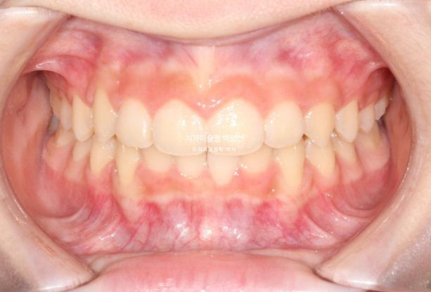 과개교합 인비절라인 모더레이트 컴프레헨시브 중심선 토끼이빨 관련 이미지 11