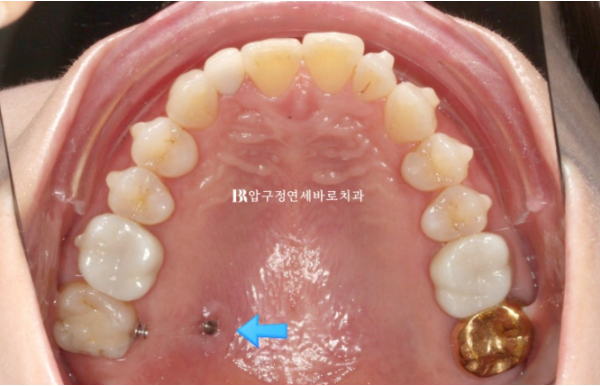 40대 발치교정 대신 인비절라인 라이트? 10개월 치료로 어디까지 가능할까요? 관련 이미지 8