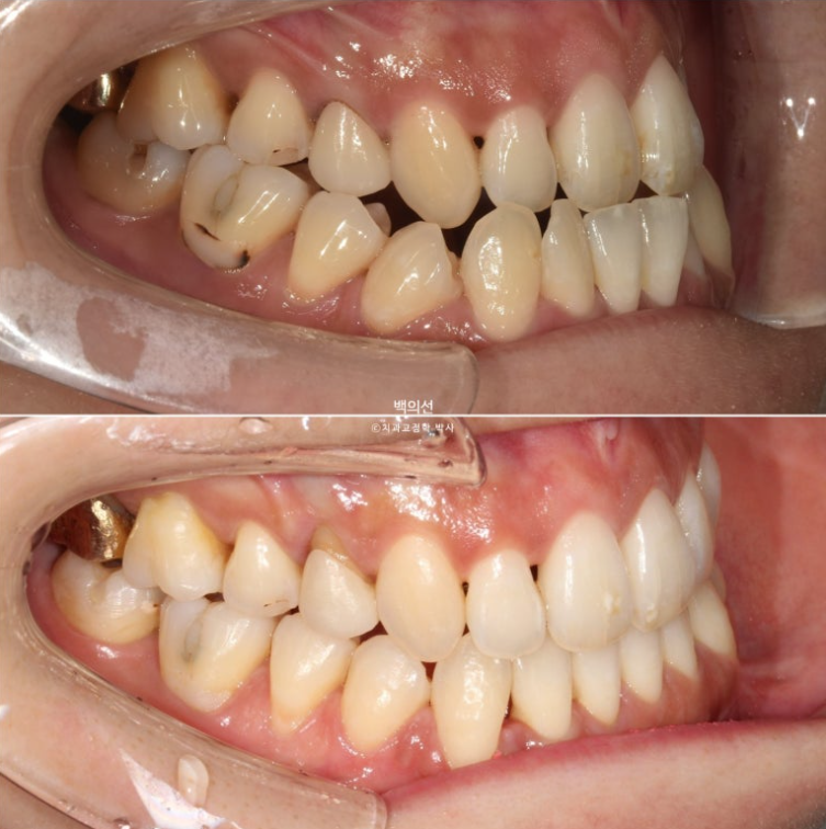 30대 비수술 비발치 주걱턱 부정교합 인비절라인 교정 관련 이미지 13