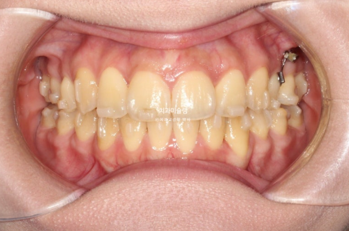 30대 인비절라인 덧니 발치교정 개방교합 치료 관련 이미지 14