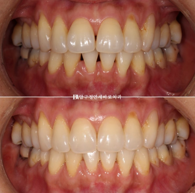 How Can Black Triangles Be Removed? Is Re-treatment Orthodontics an Option? image 1