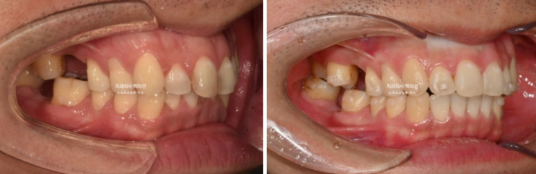 40대 인비절라인 라이트 과개교합 과잉치 덧니 교정 임플란트 보철 교정 후기 관련 이미지 12