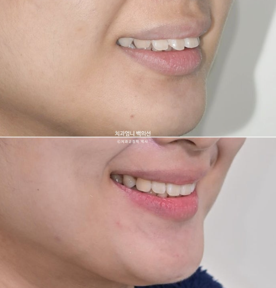 돌출입 교정 인비절라인 발치 교정 후기 관련 이미지 22