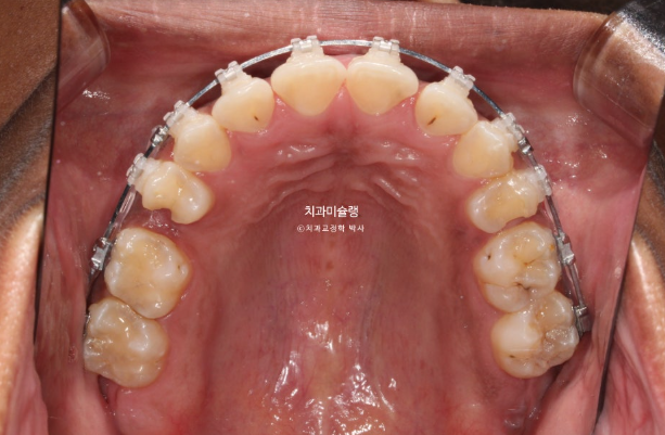 Extraction & re-orthodontics with Clippy-C, intrusion for dental implant. 관련 이미지 10