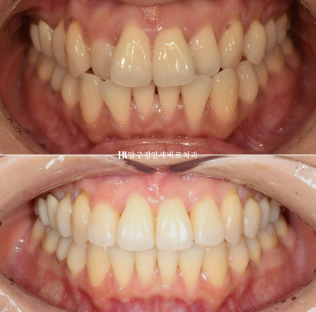 30대 토끼이빨 교정 반대교합 앞니 부분교정 후기 관련 이미지 1