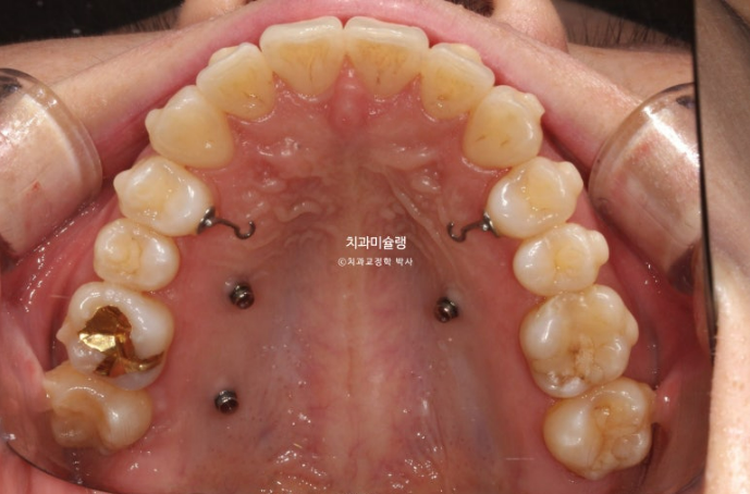 비발치 돌출입 인비절라인 교정 가위교합 중심선 맞추기 관련 이미지 10