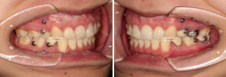 돌출입 발치 교정 인비절라인 후기 미니스크류 관련 이미지 13