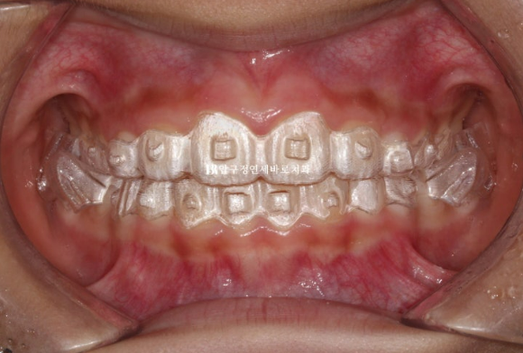 Invisalign First Correction for a Retruded Chin in a Child Orthodontic Treatment for Protrusion image 11