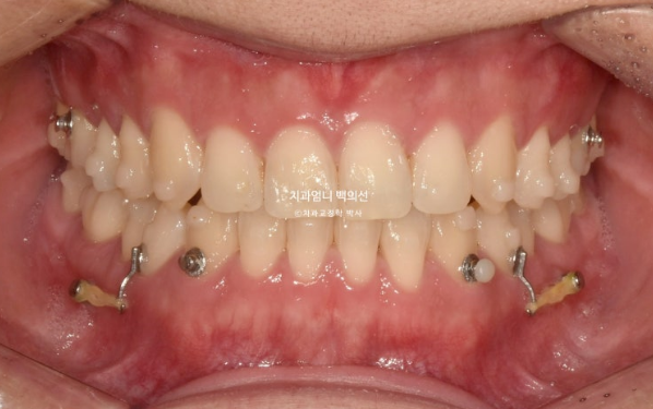 MSE Palatal Expansion Invisalign Underbite Correction, Non-Surgical image 10