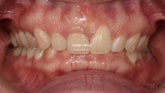 Inward-Tilted Teeth Orthodontic Treatment Review | Actual Case Improved with Non-Extraction Orthodontic Treatment for Gummy Smile, Deep Overbite & Gum Asymmetry — Gangnam Orthodontic Clinic image 2