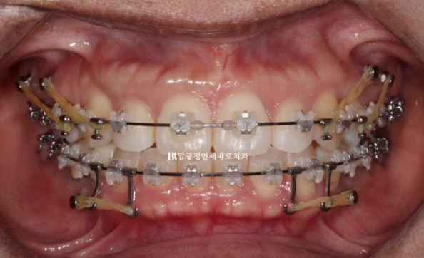 40대 재교정 가능할까요? 비발치 돌출입 교정 호두턱 팔자주름 후기 관련 이미지 3