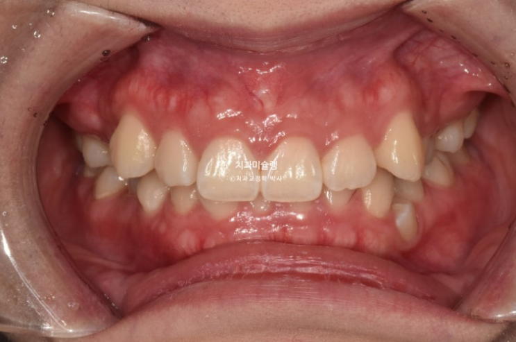 잇몸미소 거미스마일 치료 옥니 교정 잇몸성형 후기 관련 이미지 2